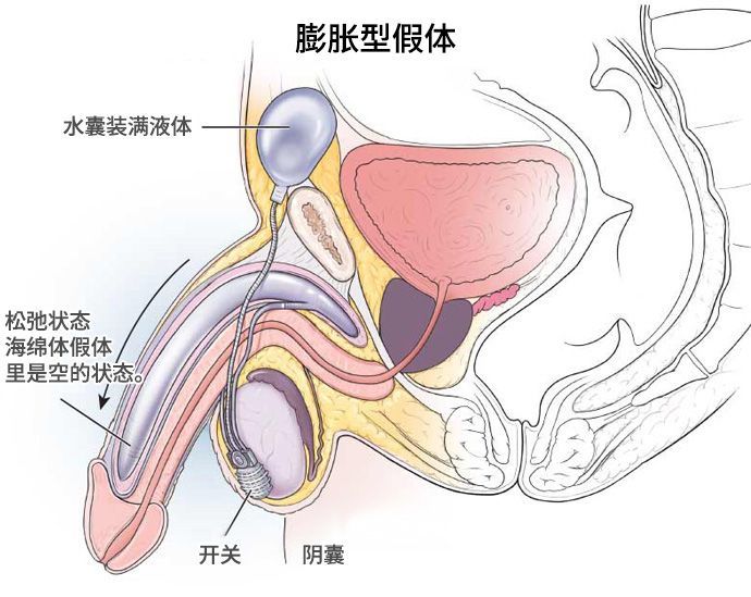 阴茎假体植入手术：重度器质性ED的终极方案